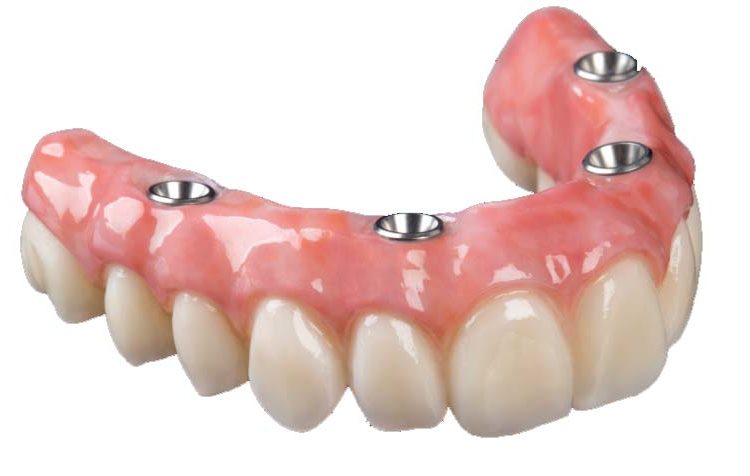 Implant Retained Dentures