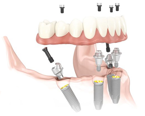All On 4 Dental Implants
