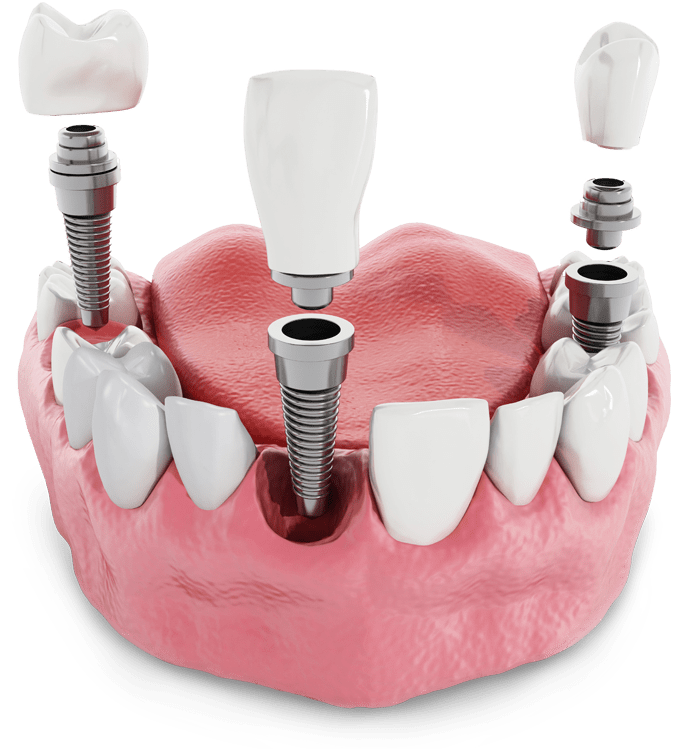 Dental Implants
